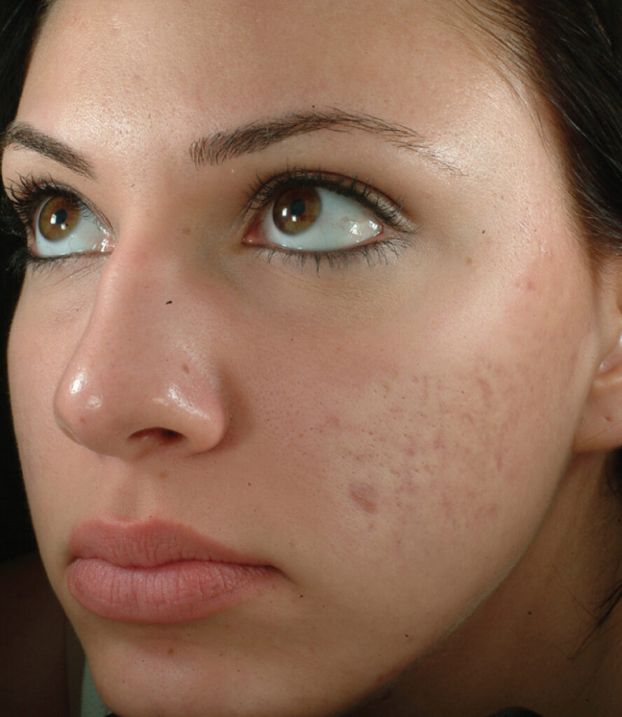 microdermabrasion acne scars